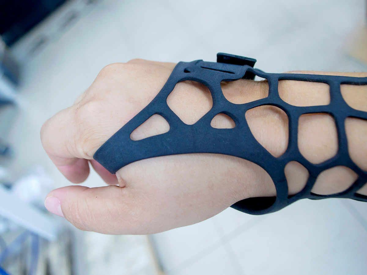 Prothèses imprimées à partir de l'imprimante 3D